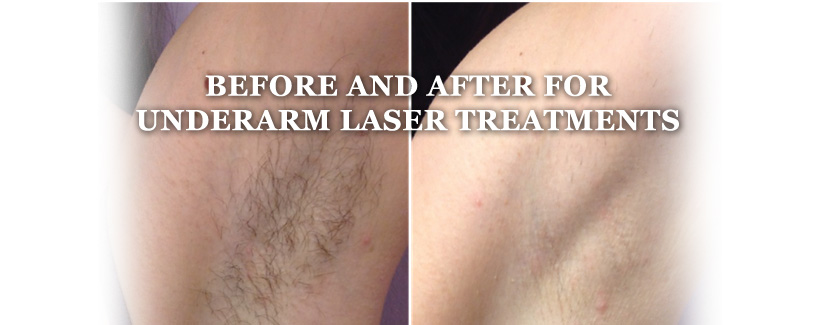 Laser Hair Removal St Thomas - Banner 2